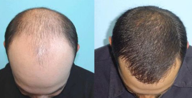 PRP DESTEKLİ FUE TEKNİĞİ İLE SAÇ EKİMİ